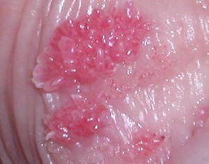 Фото кондилом на половых органах