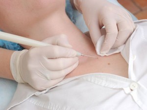 Изображение процесса удаления папилломы