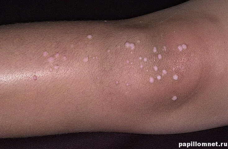 Фото плоской бородавки