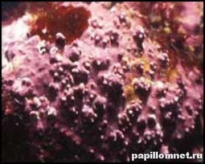  Фото кондиломы под многократным увеличением
