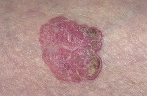 Фото кожного покрова с болезнью Боуэна