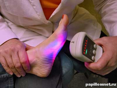 Фото процедуры лазерного удаления бородавки