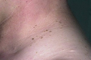 Фотография шеи на которой появились папилломы