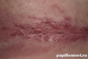 Фото остроконечных кондилом