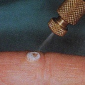 Фото процедуры криодеструкция Фото процедуры криодеструкция