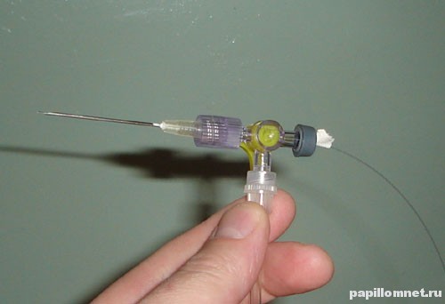 Фото процедуры Лазерная деструкция