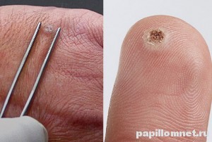 Фото папилломы на теле человека