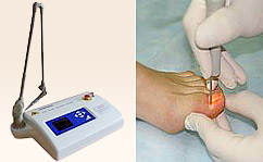 Фото процедуры электрокоагуляция Фото процедуры электрокоагуляция