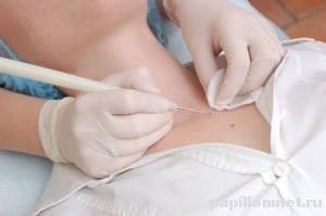На фото показано лечение папилломы по средствам хирургического удаления