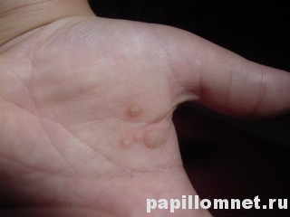 Фото обычной бородавки