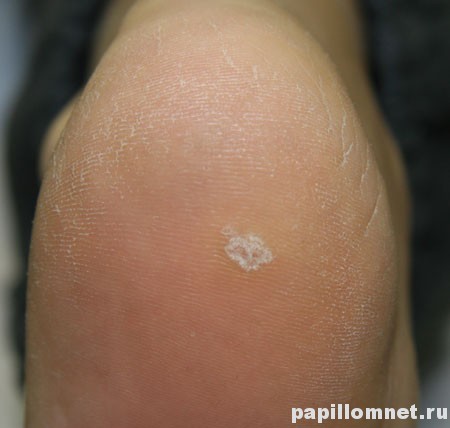 Фото подошвенной бородавки