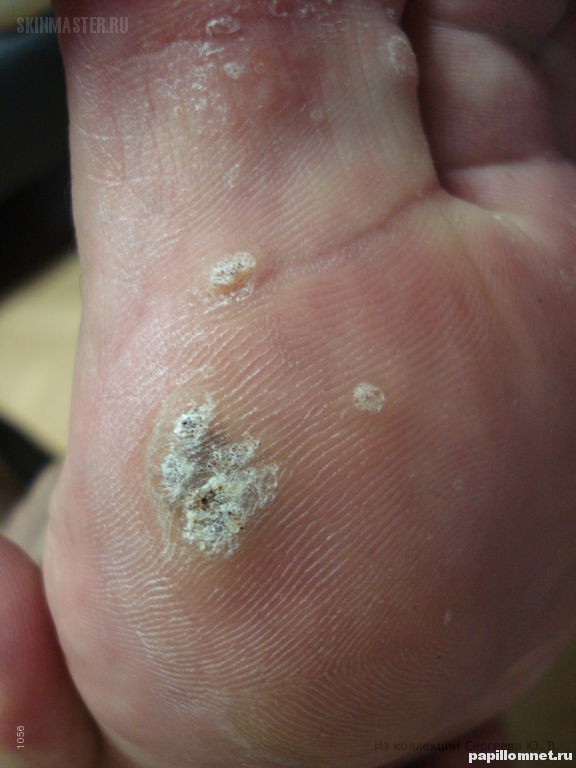 Фото пример вульгарных бородавок