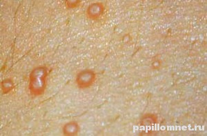 Фото кожи с высыпаниями контагиозного моллюска Фото кожи с высыпаниями контагиозного моллюска
