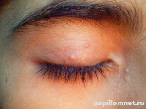 Фото контагиозного моллюска на веке