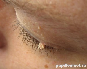 Фото бородавки на лице, а именно на веке