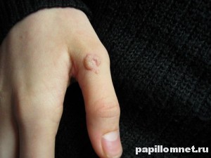 Фото бородавки на пальце