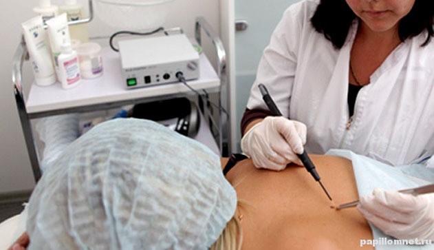 Фото процедуры Электрокоагуляция Фото процедуры Электрокоагуляция