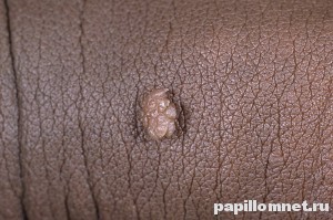 Фото кондиломы на коже, причиной появления является вирус папилломы человека