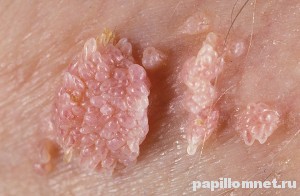 Фото кодиломы на половом органе Фото кодиломы на половом органе