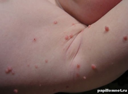 Фото проявления заболевания в подмышечной зоне