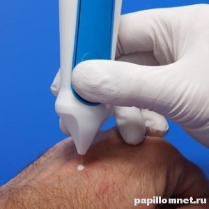 Фото криодеструкции