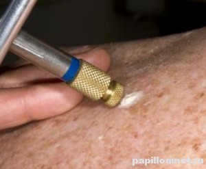 Фото процедуры криотерапия