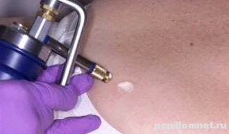 Фото процедуры Криодеструкция Фото процедуры Криодеструкция