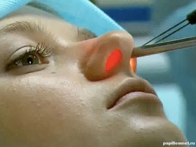 Фото процедуры удаления полипа с использованием лазера Фото процедуры удаления полипа с использованием лазера