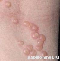 Фото высыпаний контагиозного моллюска Фото высыпаний контагиозного моллюска