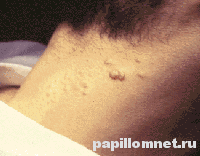 Фото проявления заболевания на шее