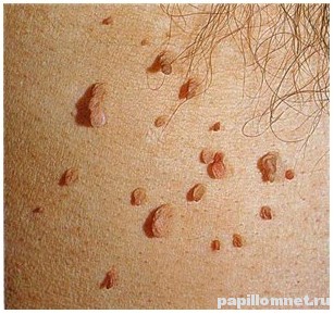 Фото пример обыкновенных папиллом
