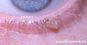 Фото проявления папилломы на веке человека Фото проявления папилломы на веке человека
