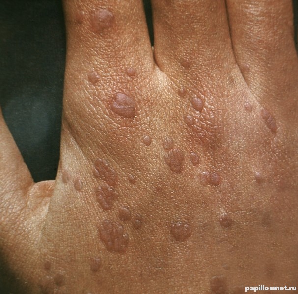 Фото пример плоских бородавок