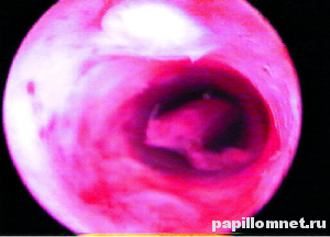 Фото процесса цитологического исследования на предмет полипов шейки матки