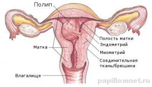 Схема матки с возможным размещением полипа Схема матки с возможным размещением полипа