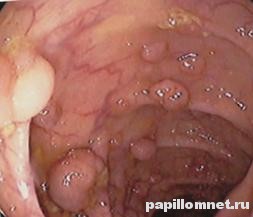 Фото полипов в кишечнике Фото полипов в кишечнике