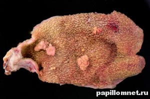 Фото полипов желчного пузыря