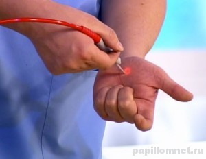 Изображение руки на которую действуют лучи лазера