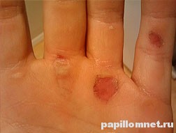 Фото мозолей на руках человека