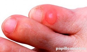 Фото мезинца ноги с водяной мозолью