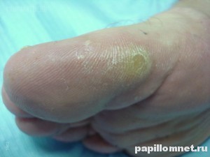 Фото костной мозоли