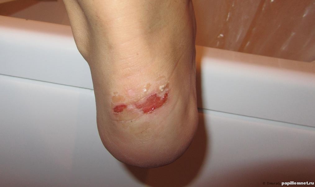 Фото кровавых мозолей на ноге