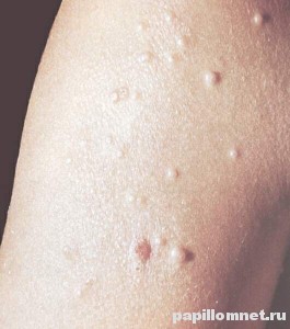Фото проявления контагиозного моллюска на коже человека