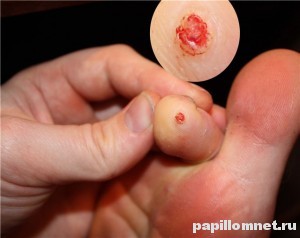 Фото мозоли на пальце ноги