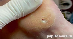 Фото ног с пемзой к статье о мозолях на подошве