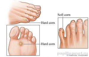 Фото схема мозолей на пальцах ног