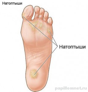 Фото схема образования нотоптышей на стопе