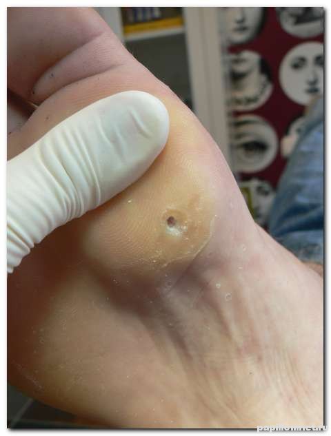 Фото натоптышей со стержнем