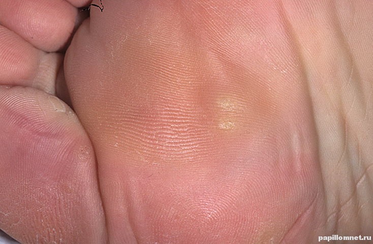 Фото обычных натоптышей