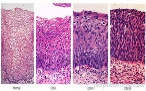 Фото изменения структуры тканей при папилломе шейки матки